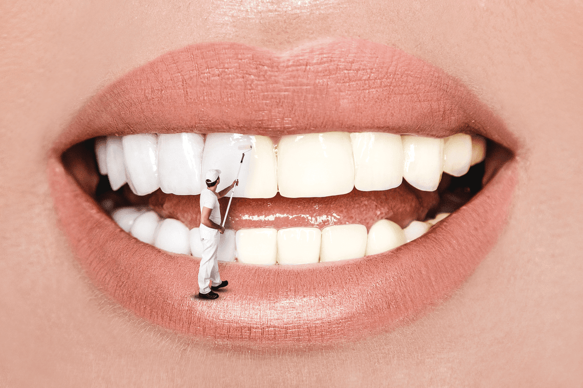 Snap on Smile: Precio en Farmacias y Todo lo que Necesitas Saber sobre esta Solución Dental Estética